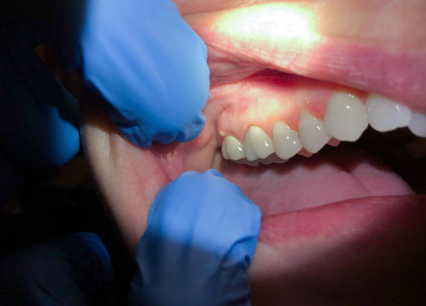 Best Emergency Dental Care for Broken or Chipped Teeth in Newark, NJ